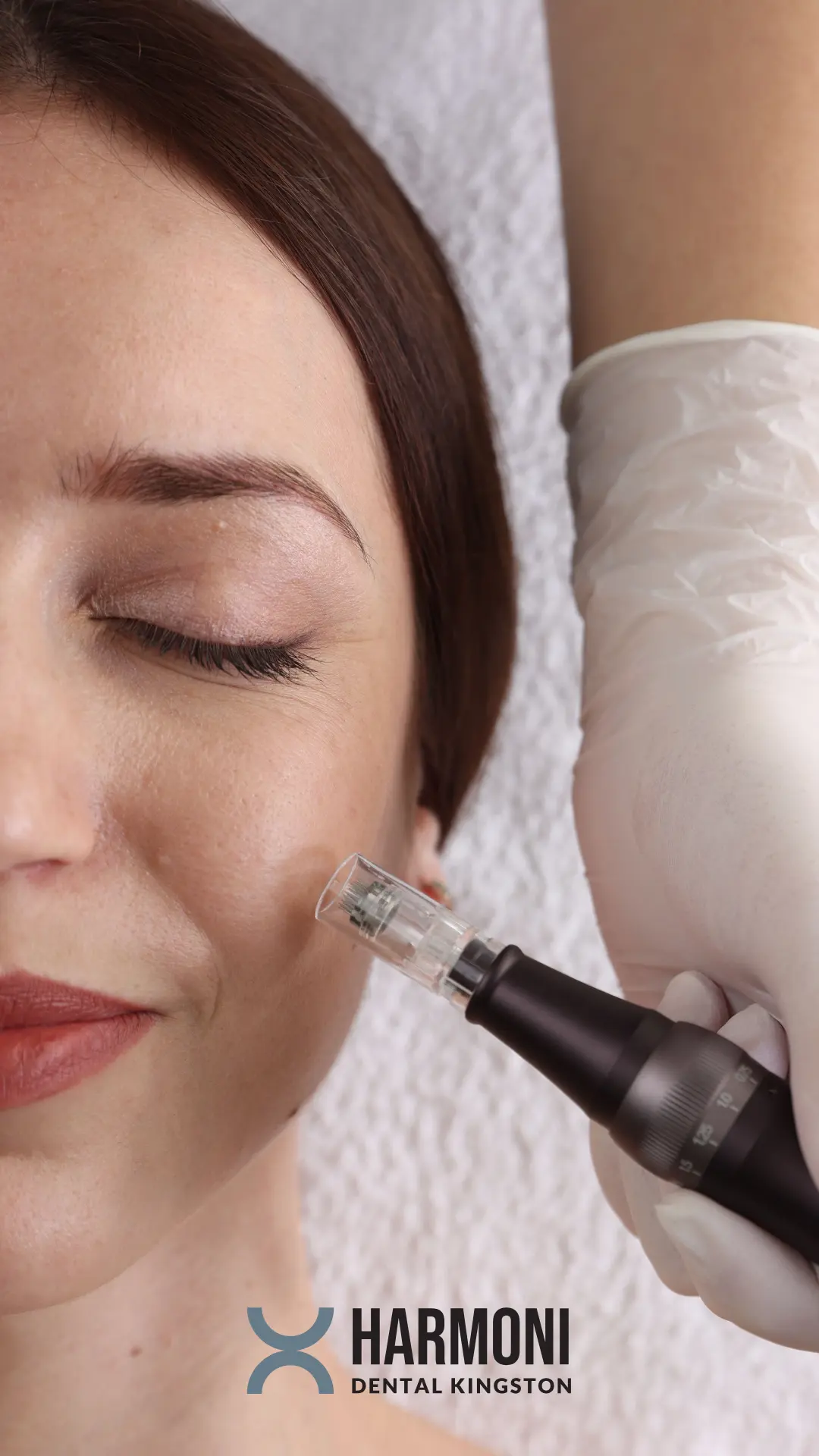 RF Microneedling Treatment in Norbiton, Kingston-upon-Thames